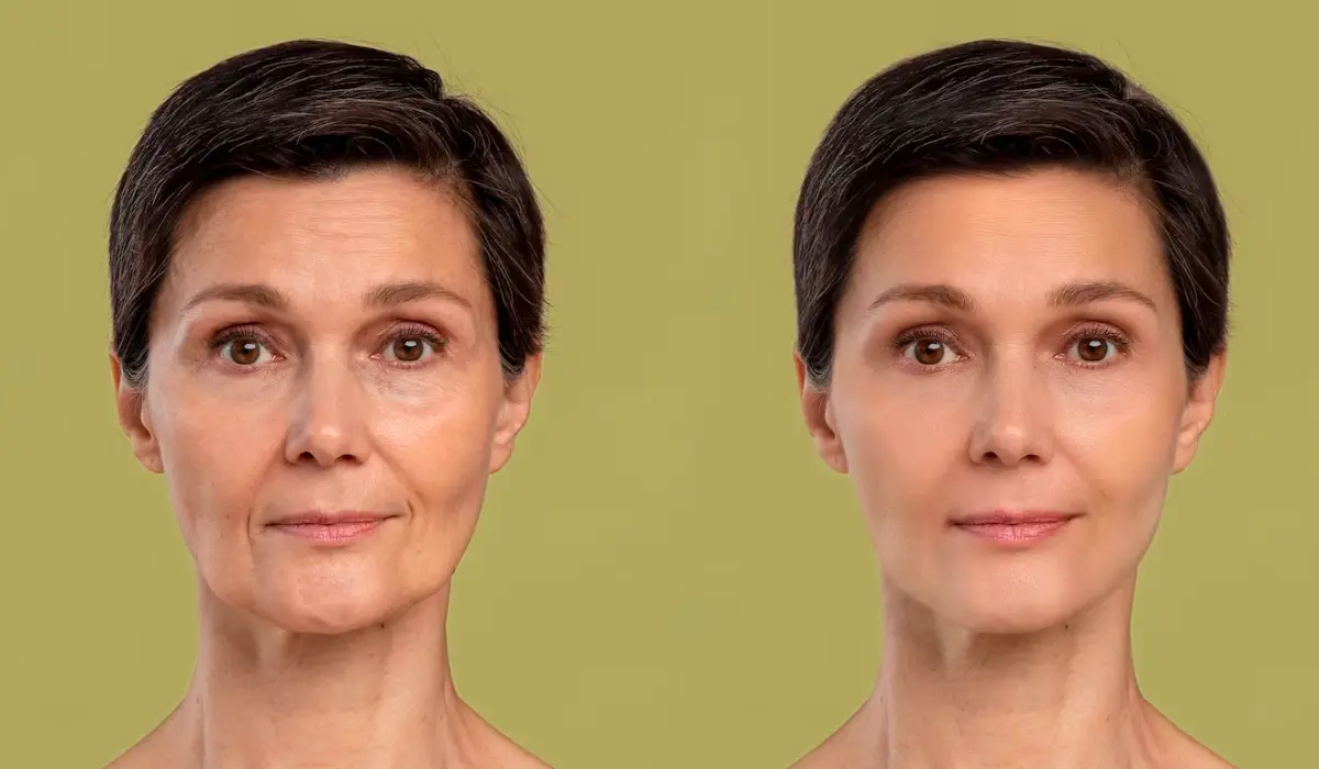 Botox  Before And After Result