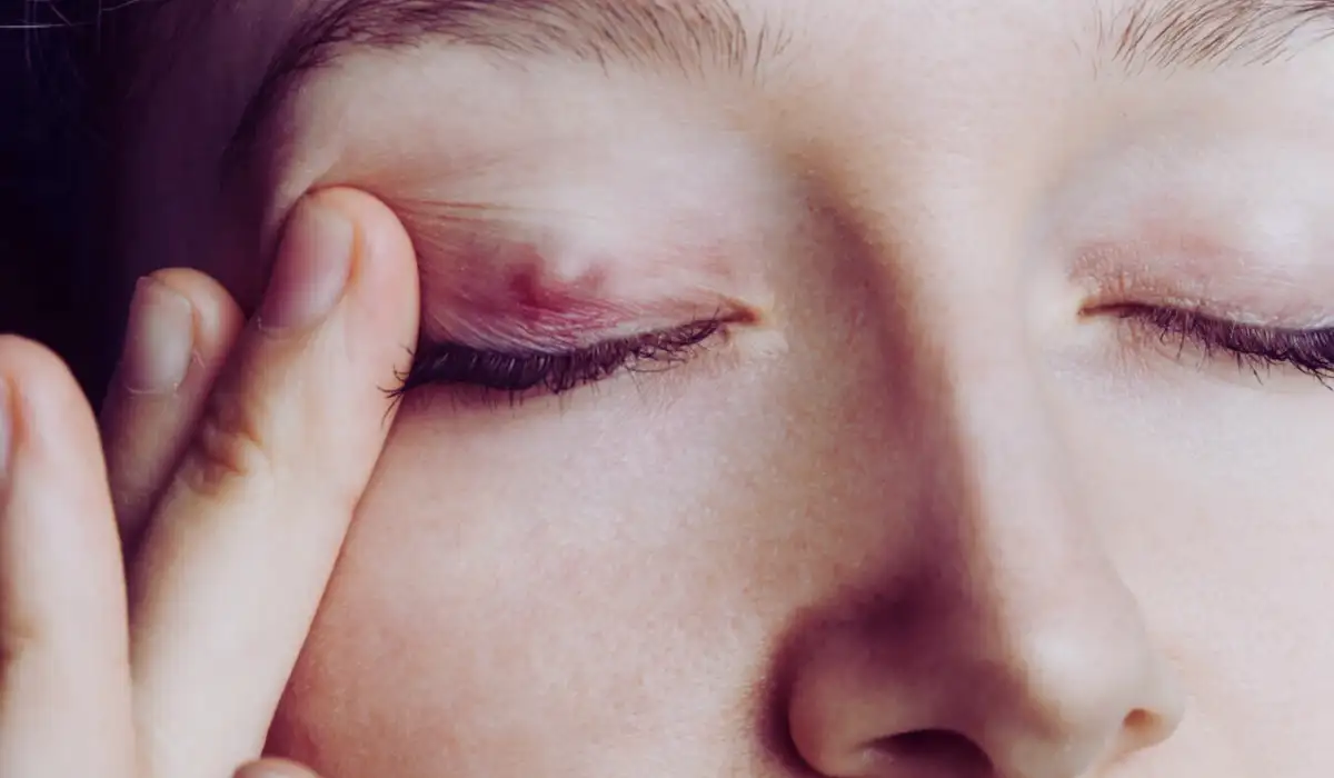 Chalazion Eye Disease
