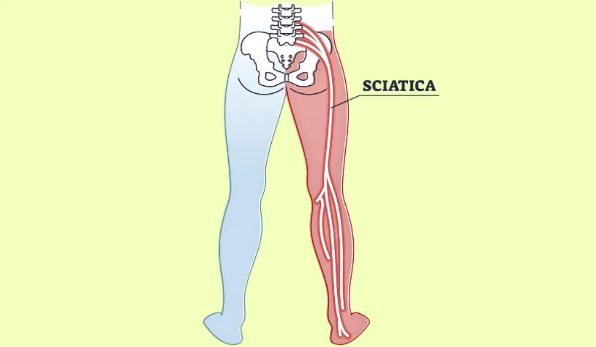 Last Stages Of Sciatica
