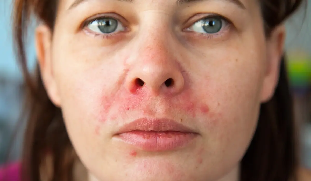 Signs Of Healing In Perioral Dermatitis