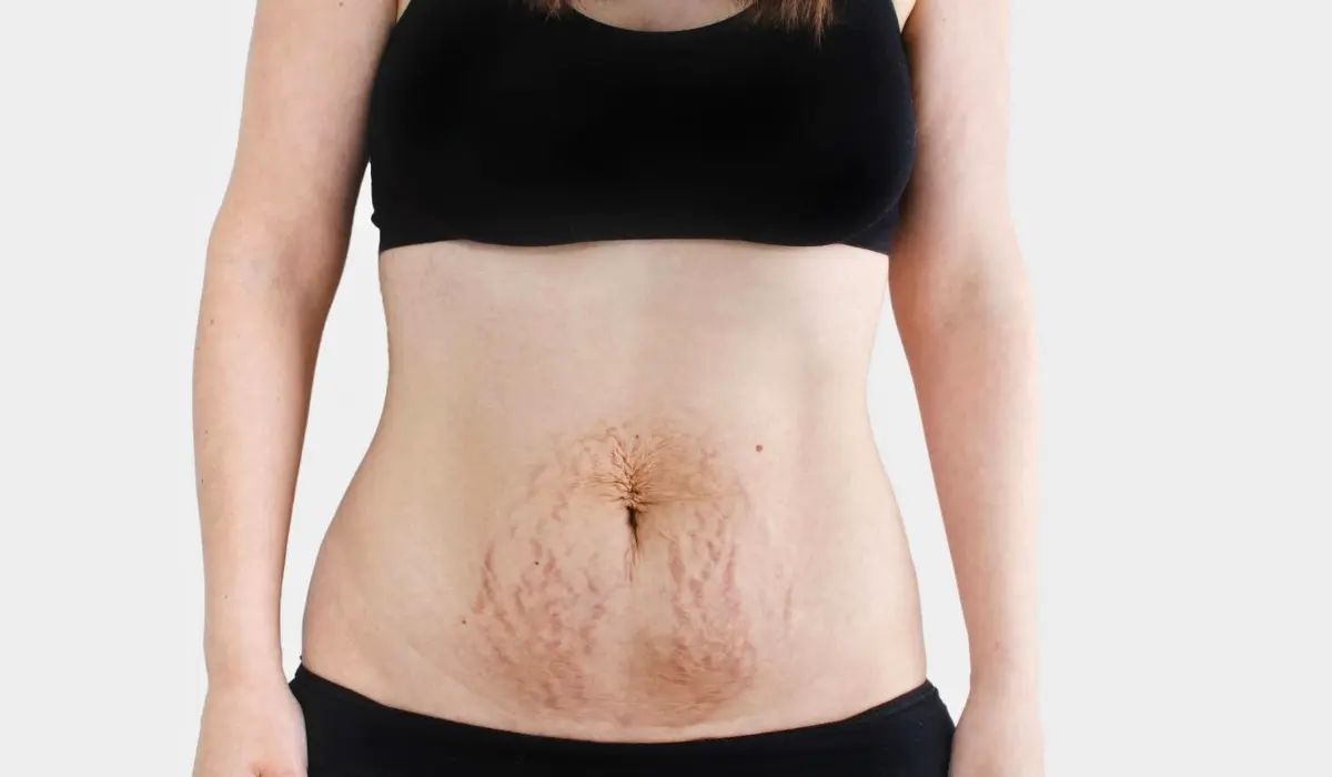 Stretch Marks And Weight Loss