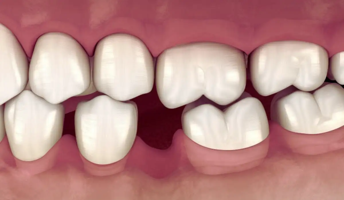 Teeth Shifting Places