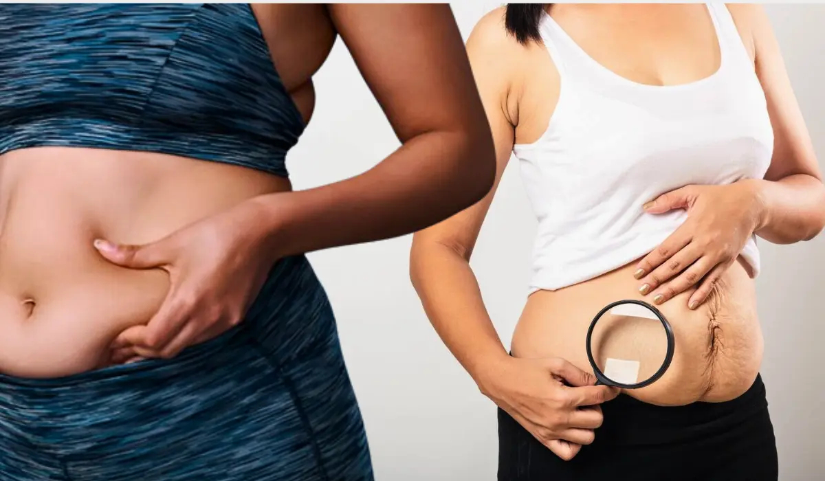 Understanding How Weight Loss Relates To Stretch Marks