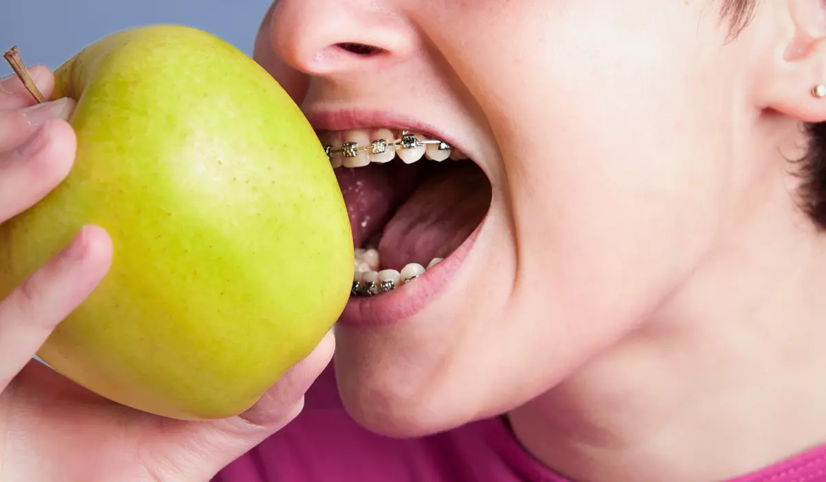 What To Eat With Braces During The First Week